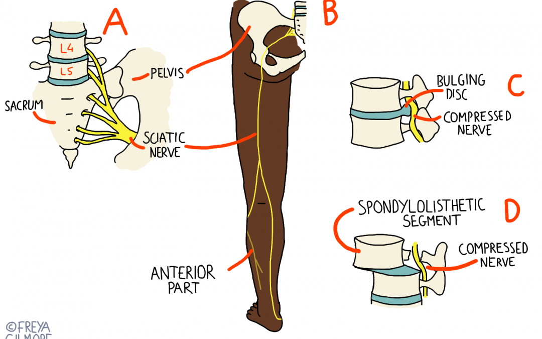 Sciatica and Osteopathy