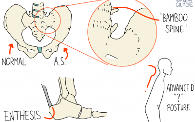 Ankylosing Spondylitis and AxSpA