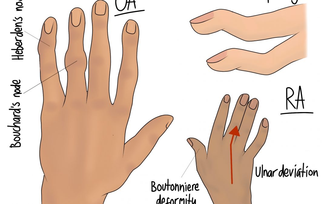 Arthritic Pain