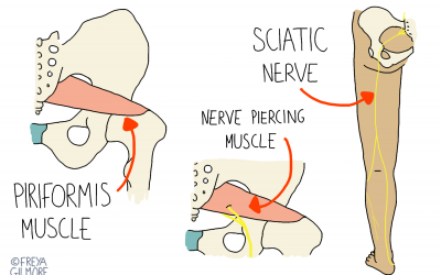 Piriformis Syndrome