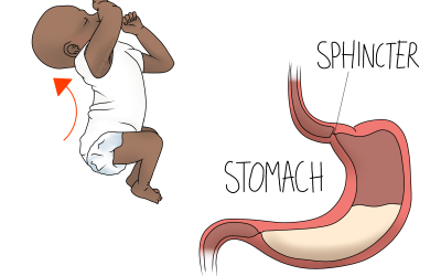 Reflux in Babies
