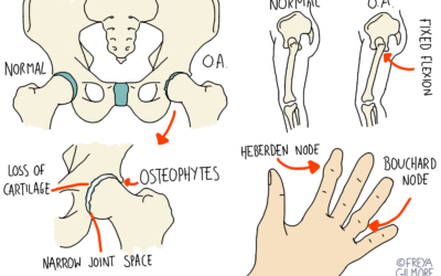 Arthritis in the Hip and Knee
