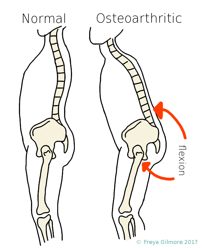 Arthritis in the hip and its effects on general posture