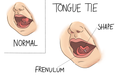 Tongue Tie