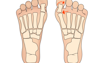 Bunion: Hallux Valgus
