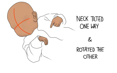 Infant Torticollis