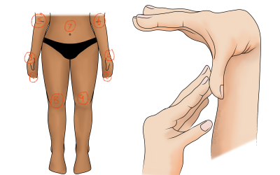 Hypermobility