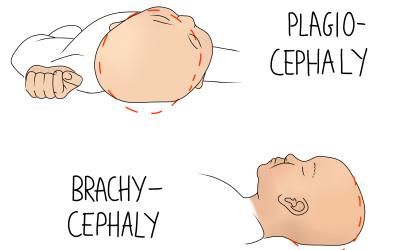 Plagiocephaly