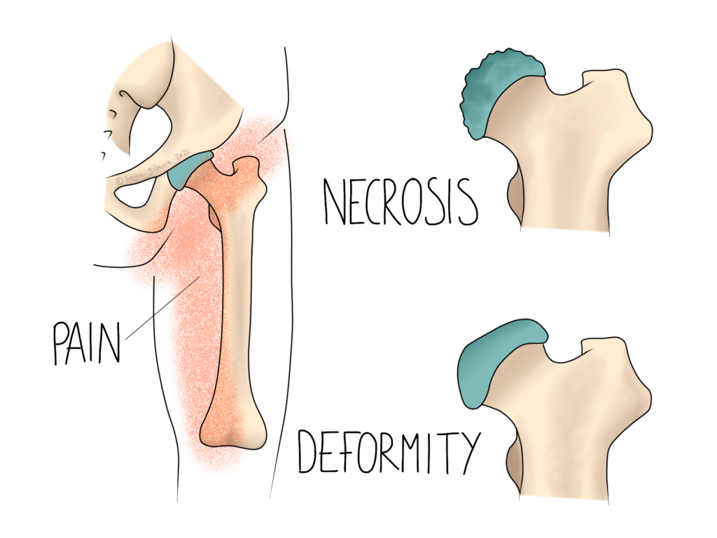 Perthes’ Disease