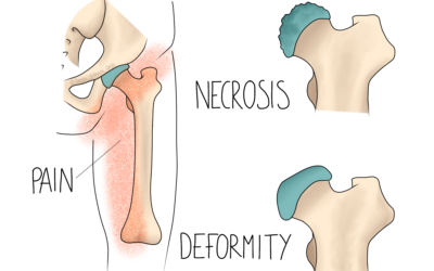Perthes’ Disease
