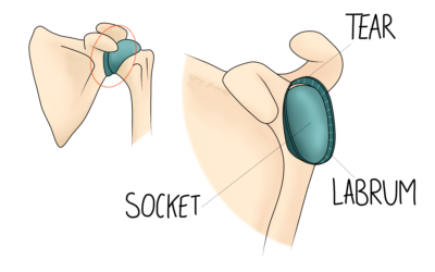 Labrum Tears