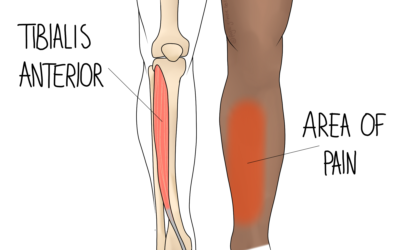 Shin Splints
