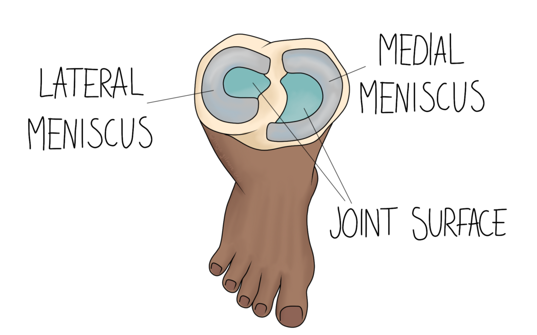 Meniscus Tears