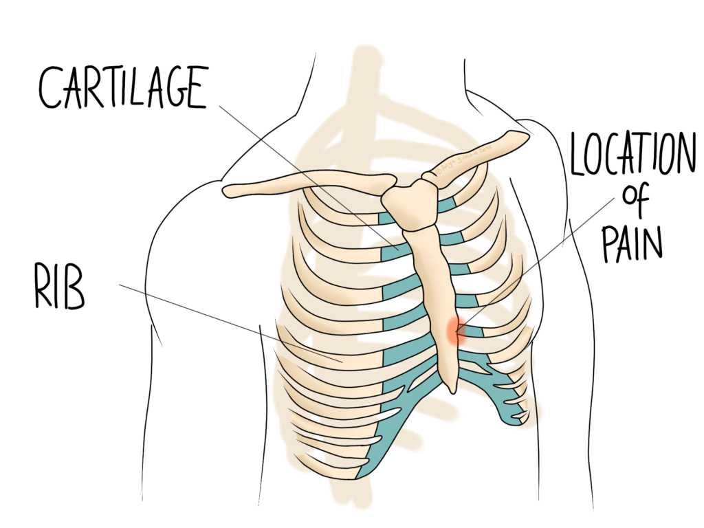 Rib Pain Costochondritis Wiltshire Osteopathy rib-pain-costochondritis-wiltshire-osteopathy