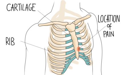 Rib Pain: Costochondritis