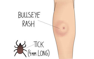 Lyme Disease