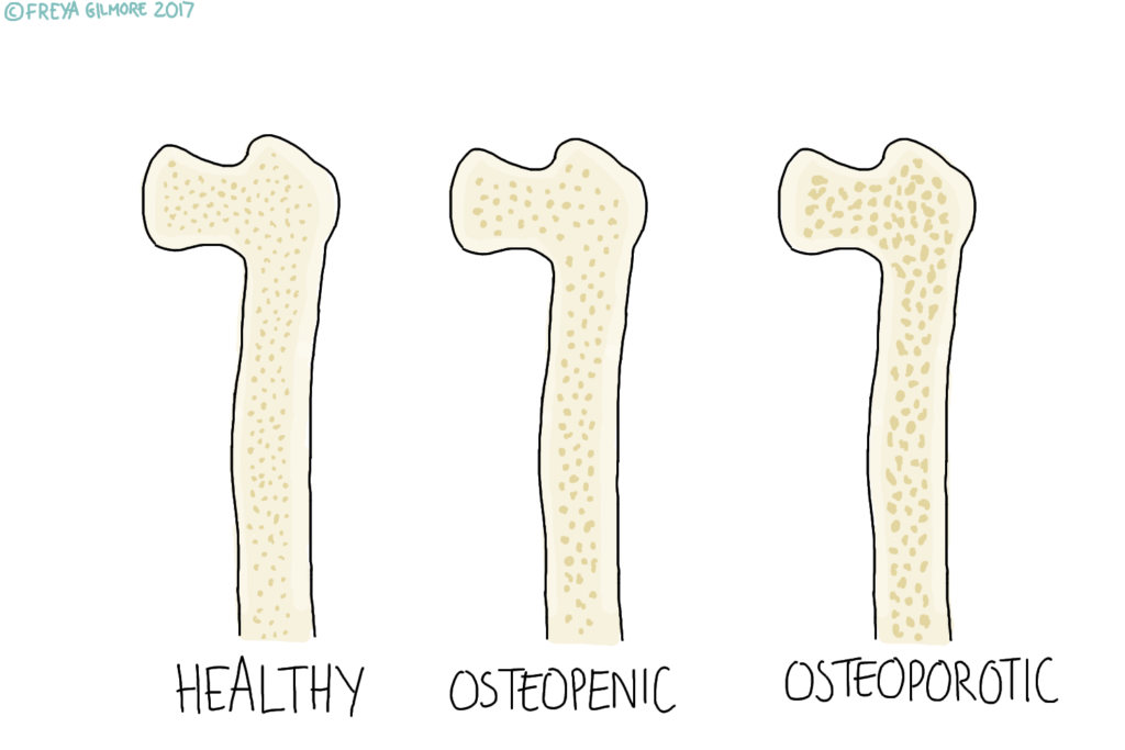 Osteoporosis and Osteopenia