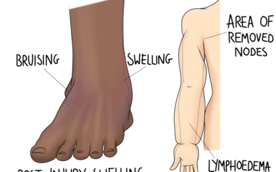 Circulation Issues