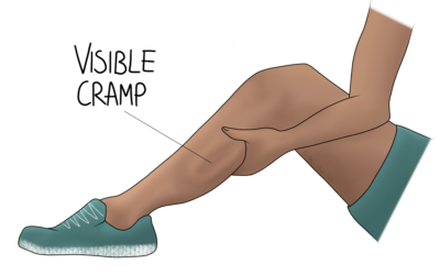 Muscle Cramps