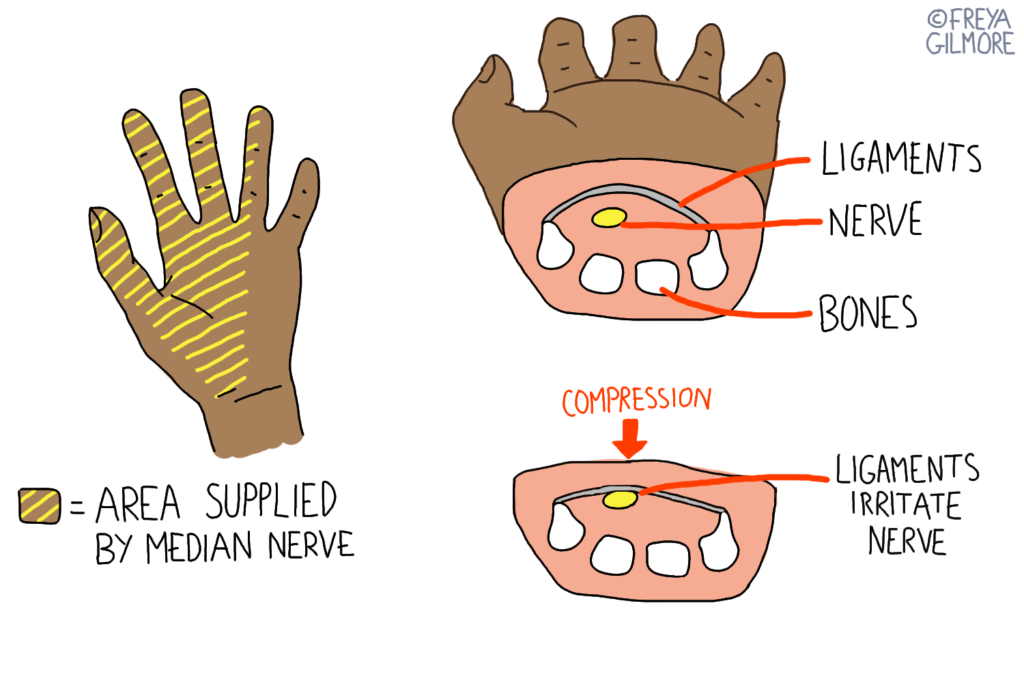 Carpal Tunnel Syndrome