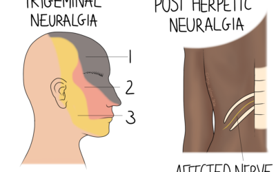 Neuralgia