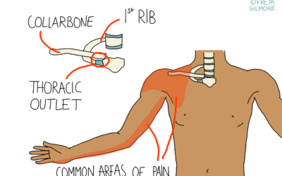 Thoracic Outlet Syndrome
