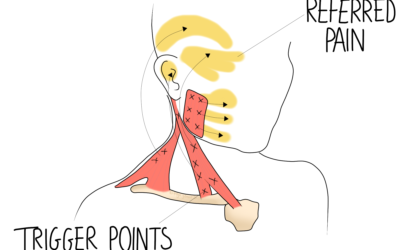 Trigger Points