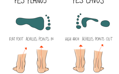 Flat Feet & High Arches