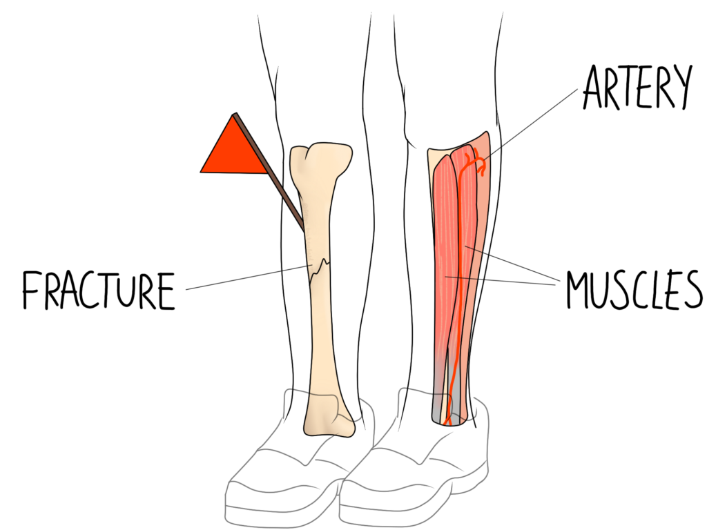 Compartment Syndrome Wiltshire Osteopathy