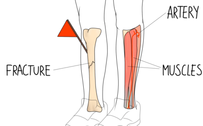 Compartment Syndrome