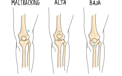 Knee Cap Pain and Problems