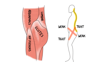 Lower Cross Syndrome