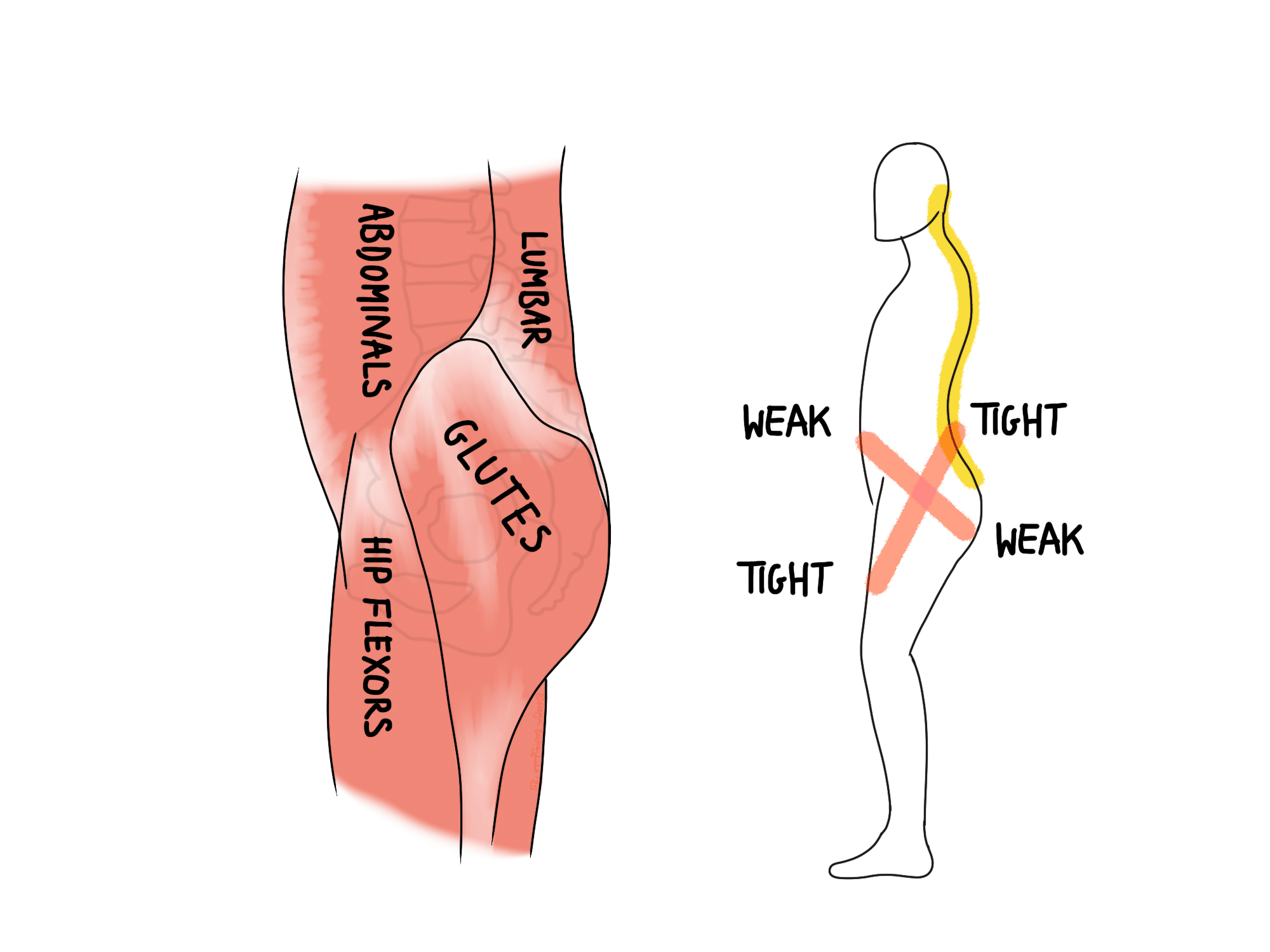 Fixing Lower Crossed Syndrome Upper Crossed Syndrome [CASE STUDY]