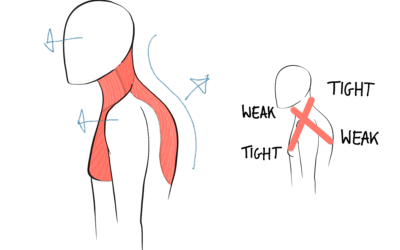 Upper Cross Syndrome