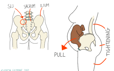 Sciatica in Pregnancy
