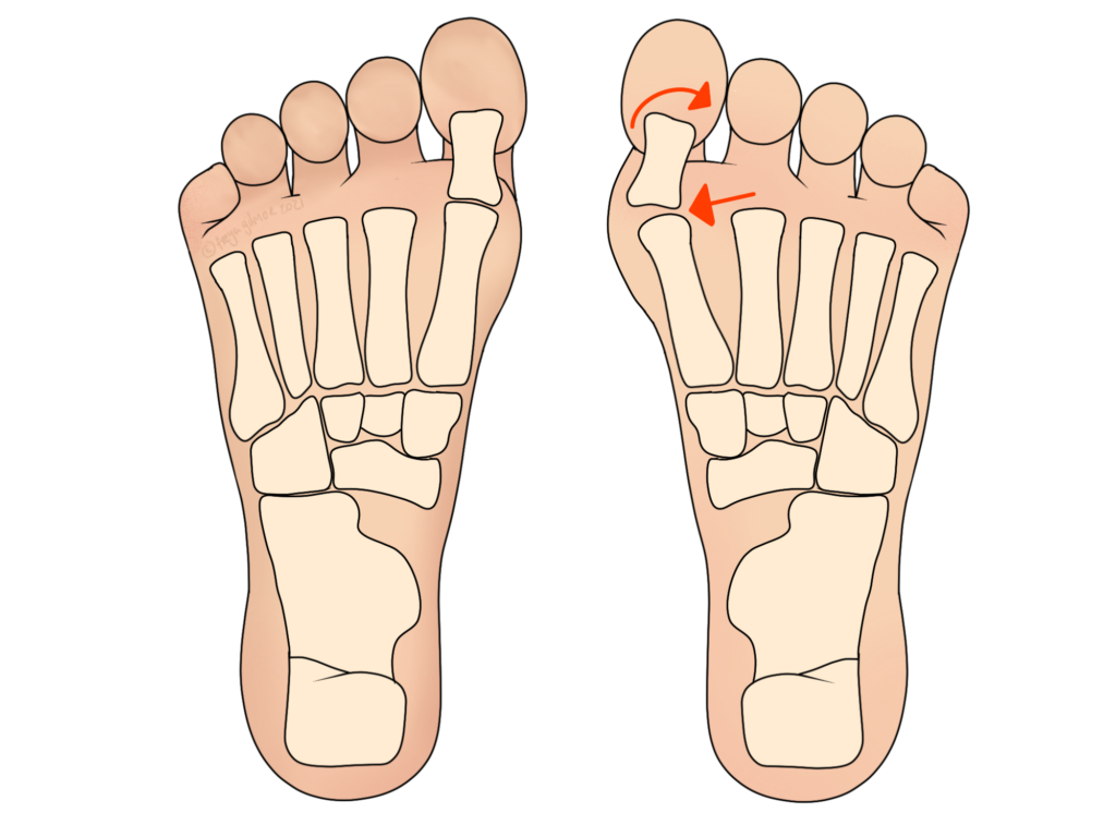 Foot and ankle pain: bunions