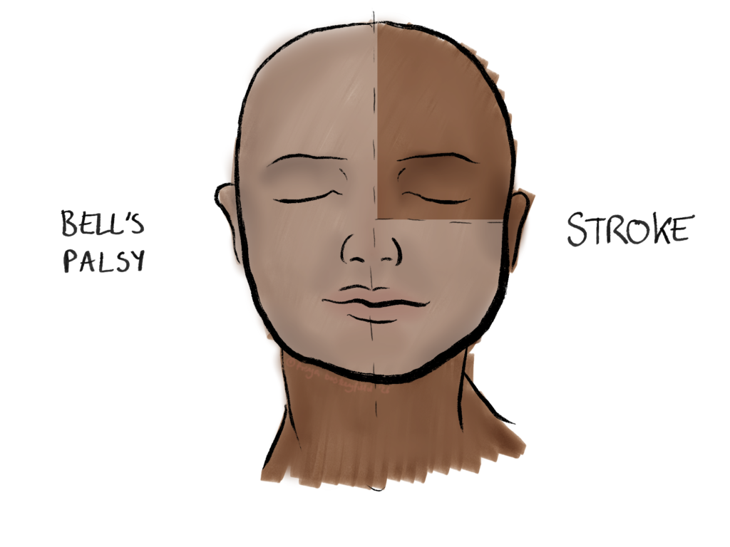 areas affected by stroke vs bells palsy