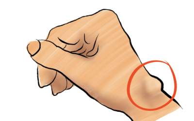 Ganglion Cysts