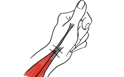 De Quervain’s Tenosynovitis
